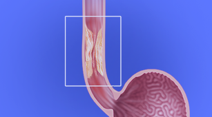 Banner Minimally Invasive Esophagectomy