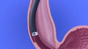 Banner Esophageal Surgery
